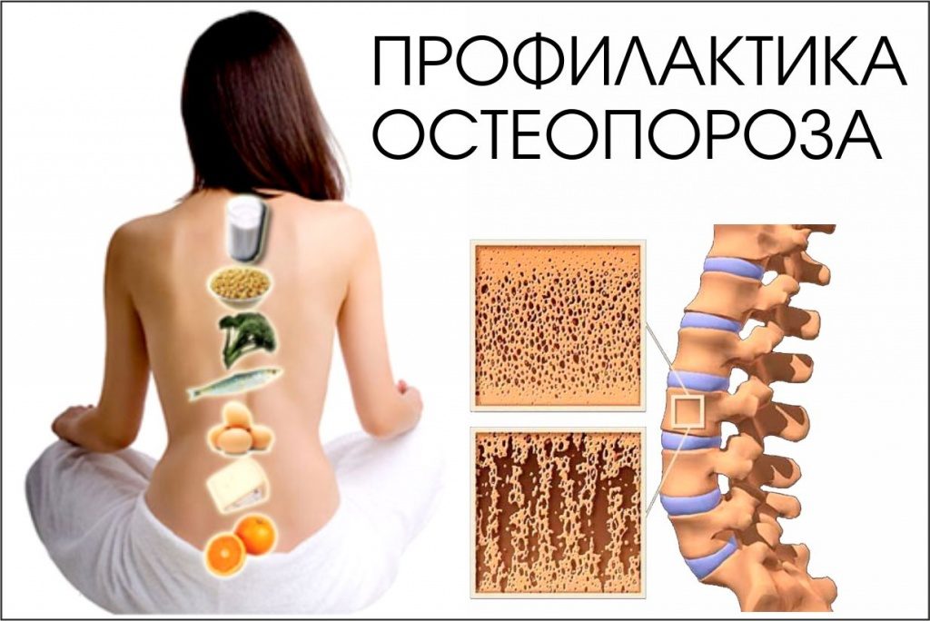 Остеопороз — симптомы и лечение